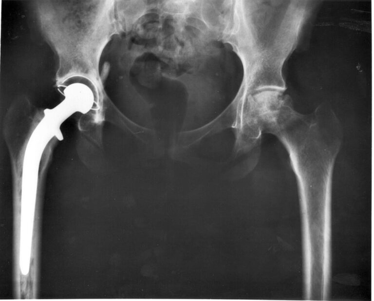 Patients Expected Profemur Artificial Hips to Last. Then They Snapped in Half.